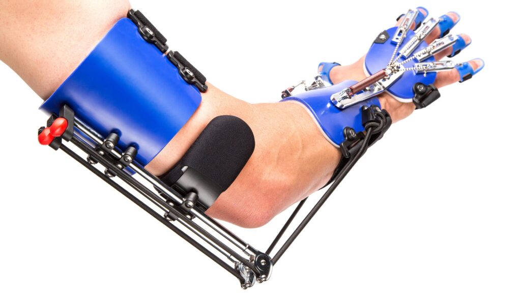 A persons hand and forearm, sporting an assistive device that looks like a robot hand.   Metal rods, chains and springs, connect each finger to the candy blue, forearm cuff.  another cough and support above the elbow is also attached with a series of springs and rods. The device is designed to assist with both, gripping, and for rehabilitation of movement and functionality of the hand.
